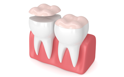 Les dents artificielles, laquelle utiliser et pourquoi ?