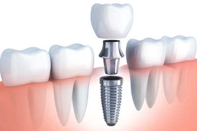 Implant dentaire Is-sur-Tille